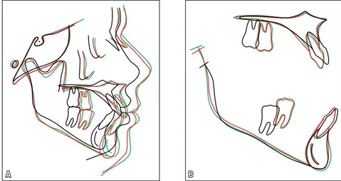 FIGURE 16 - Total (A) and partial (B) superimpositions of initial (black), final (red) and two-year posttreat- posttreat-ment (green) cephalometric tracings.