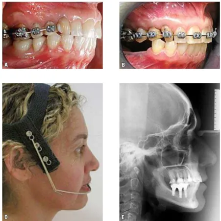 FIGURE 7 - Treatment progress.  A ) Placement  of provisional removable partial denture four  months  after  start  of  treatment