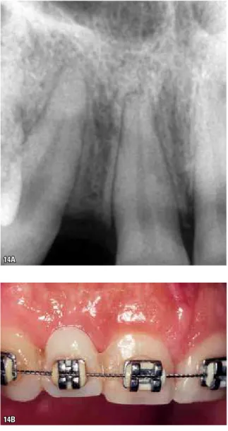 FIGURA 14 - Implante instalado na região do dente 12. Em  A , a radio- radio-grafia periapical mostra a proximidade das raízes dos dentes 11 e 13,  pela  ausência  do  incisivo  lateral,  o  que  impossibilita  a  instalação  do  implante