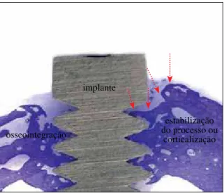 FIGURA 8 - Após a saucerização, nota-se que a superfície óssea peri- peri-implantar  regulariza-se,  com  corticalização  (setas)  indicativa  de   es-tabilização do processo de remodelação óssea pericervical (azul de  toluidina, 10X).
