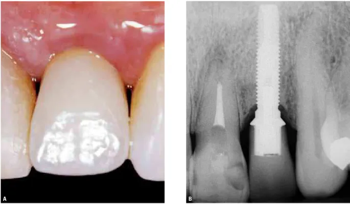 FIGURA 9 - Caso clínico de implante na região de incisivo superior lateral após 6 anos, destacando-se a saucerização com superfície óssea regular e a  osseointegração obtida