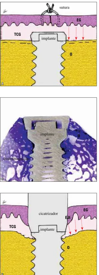 FIGURA 13 - Implantes osseointegrados submersos em  A  a  D . Nessa si- si-tuação não há saucerização; o reparo ósseo promove até parcial  reco-brimento da sua cobertura (como em  B ,  C  e  D ), pois não há formação de  epitélio juncional peri-implantar, 
