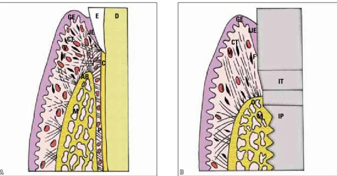 FIGURE 1 - In the normal periodontium, at  A , the collagen fibers are highlighted, extending from the gingival alveolar bone (AB) crest to the cementum (C),  gingiva and periodontal ligament (P) to form a cross-hatch pattern at the connective attachment