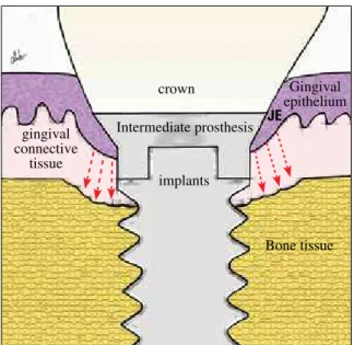 FIGURE 6 - The peri-implant junctional epithelium (JE) conforma- conforma-tion is similar to the juncconforma-tional epithelium of natural teeth