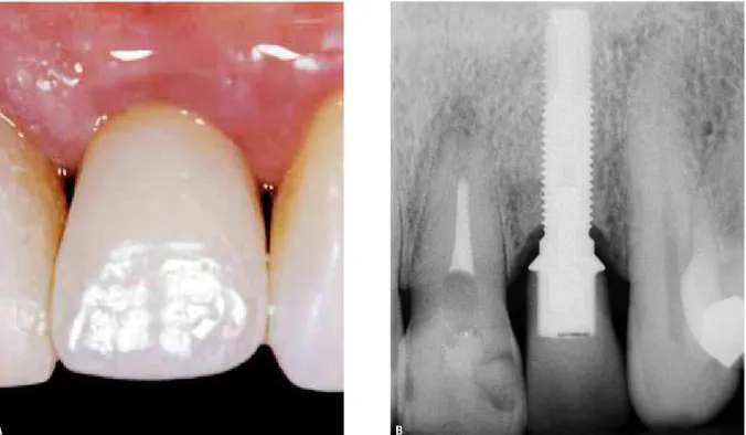 FIGURE 9 - Clinical case of implant in the upper lateral incisor region after six years, highlighting saucerization with regular bone surface and os- os-seointegration