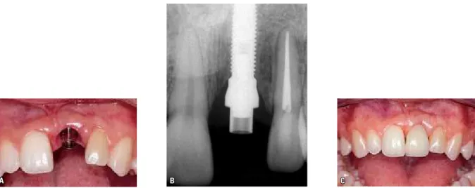 FIGURE 11 - Same clinical case as in the previous figure.  A  is a five-year control periapical radiograph showing pericervical saucerization and corticalization  of peri-implant bone tissue