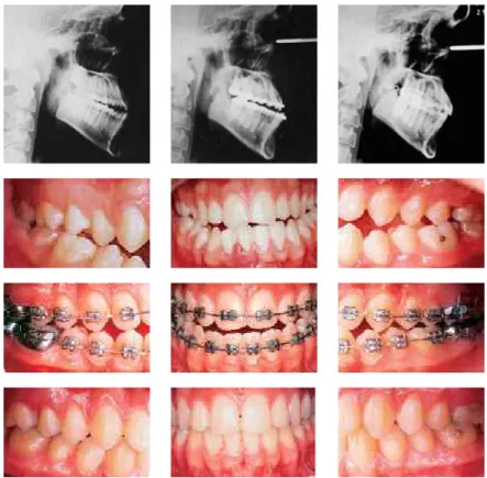 FIGURE 5 - Initial, preoperative and final phases of a Class III surgical patient. 