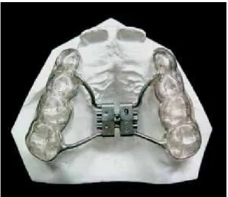 FIGURE 1 - Bonded rapid maxillary expansion appliance.