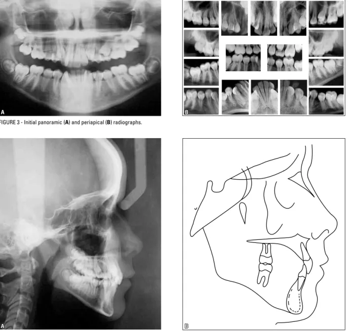 FIGURE 3 - Initial panoramic ( A ) and periapical ( B ) radiographs.