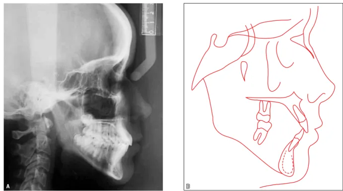 FIGURE 9 - Total ( A ) and partial ( B ) superimposition of initial (black) and final (red) cephalometric tracing.