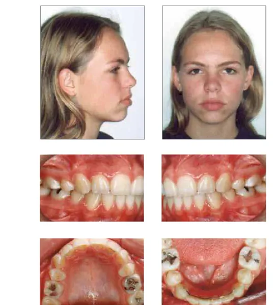 FIGURE 10 -  A ) Final cephalometric tracing.  B ) Comparison of initial and final profiles