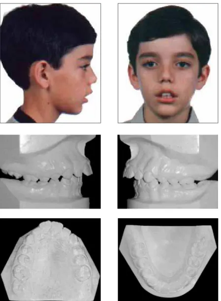 FIGURE 11 - Clinical case 4: initial facial and casts photographs.