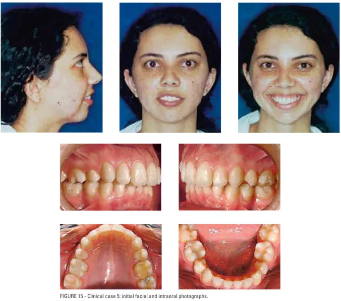 FIGURE 15 - Clinical case 5: initial facial and intraoral photographs.