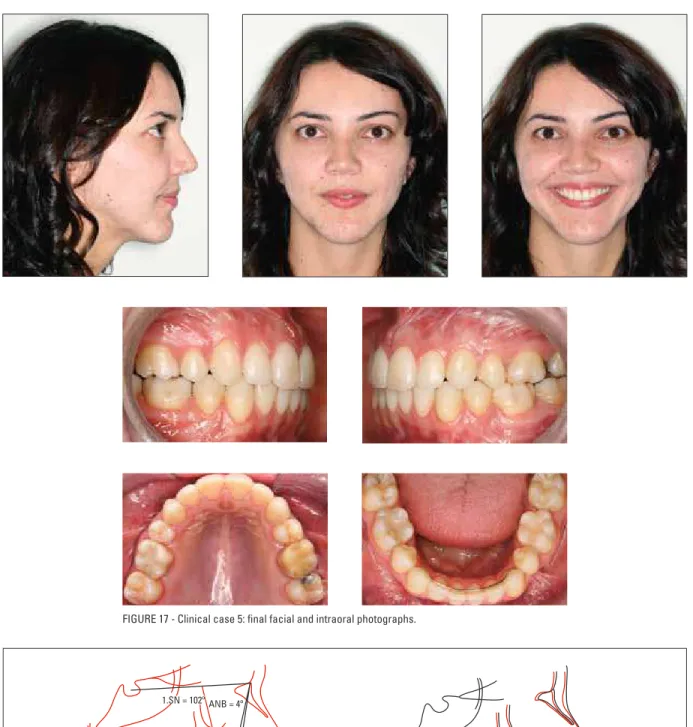 FIGURE 18 -  A ) Final cephalometric tracing.  B ) Total superimposition.