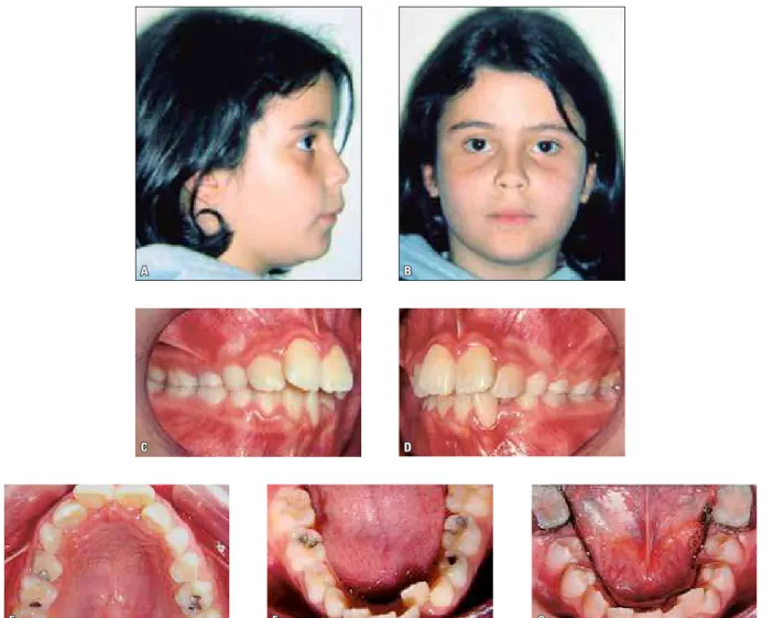 FIGURE 1 - Clinical case 1: initial photographs:  A ,  B ) facial,  C  to  F ) intraoral;  G ) lingual arch installed to use leeway space.