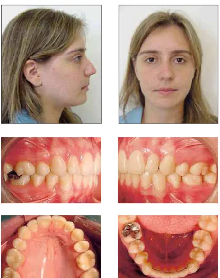 FIGURE 5 - Clinical case 2: final facial and intraoral photographs.