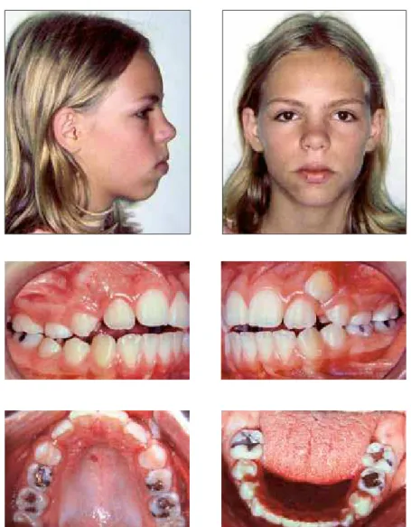 FIGURE 7 - Clinical case 3: initial facial and intraoral photographs.