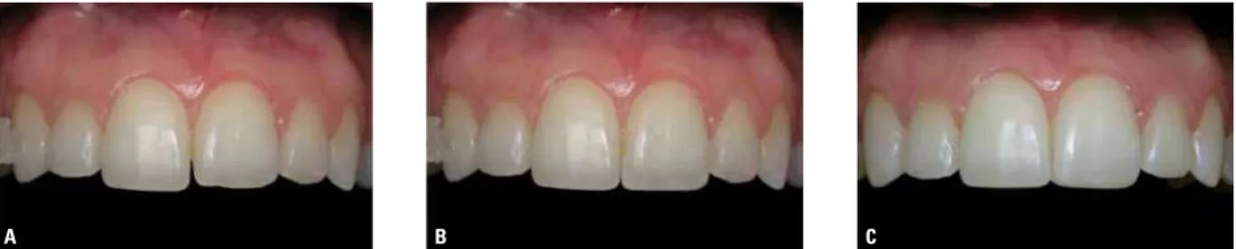 FIGURE 2 - Example of image manipulation as an auxiliary resource in planning: A) before, B) study of the gingival area to be removed in periodontal plastic  surgery and C) after the surgical outcome.