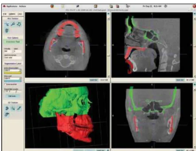 FIGURE 1 - After the registration procedure with the Imagine software,  the  superimposition  between  the  post-surgery  3D  model  (color)  and  gray scale pre-surgery image can be observed, showing matching  cra-nial bases and displaced mandibular struc