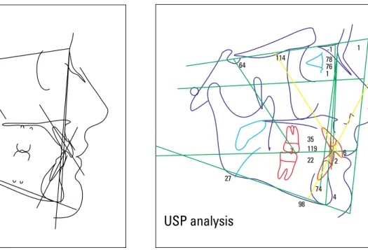FIGURE 1 - Manual cephalometric tracing. FIGURE 2 - Computerized cephalometric tracing.
