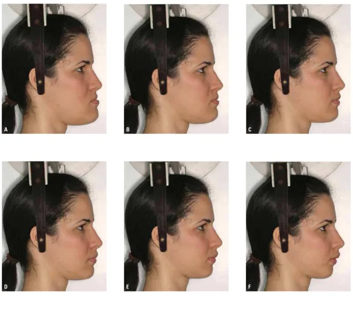FIGURE 1 - Photographs of facial profiles of Cau- Cau-casian woman with convexity angles of 0° (A),  4º (B), 8º (C), 12º (D), 16º (E), 20º (F), 24º (G) .