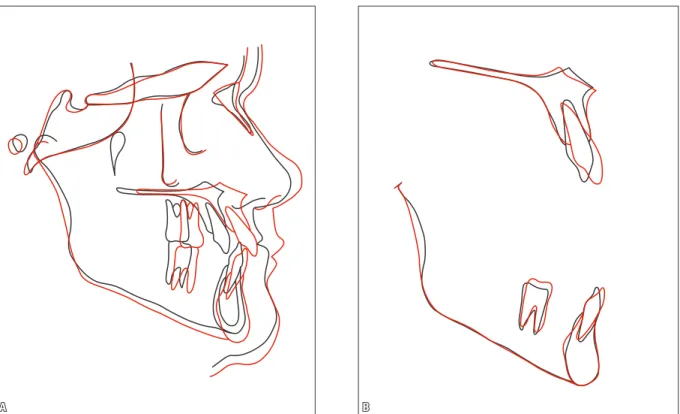 FIGURE 14 - Total (A) and partial (B) superimposition of initial (black) and final (red) cephalometric tracings.