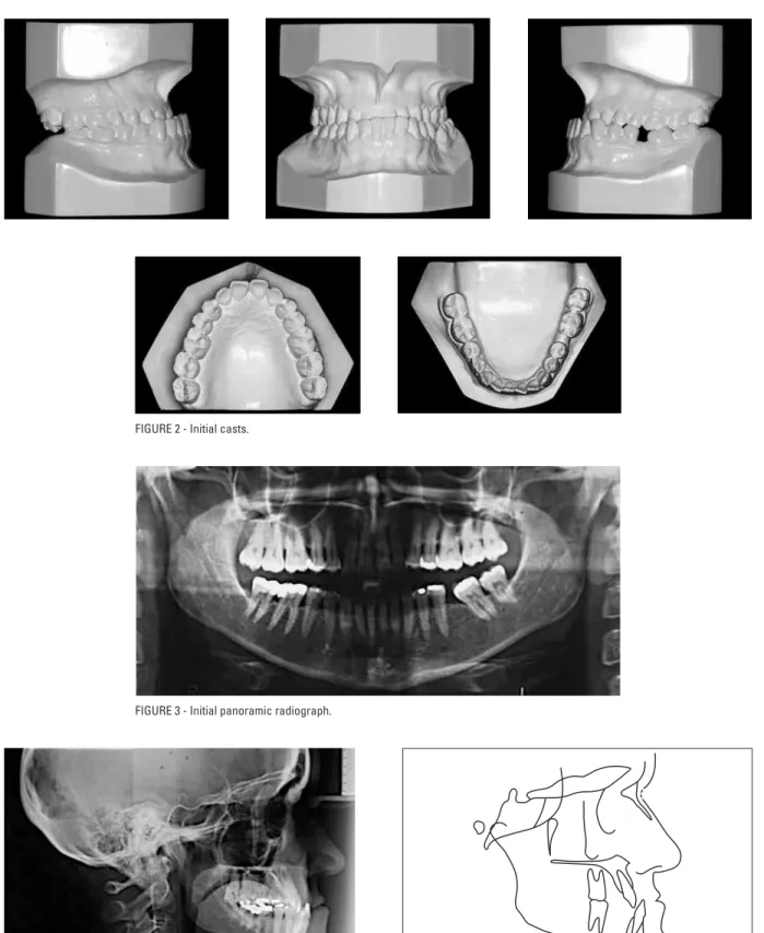 FIGURE 2 - Initial casts.