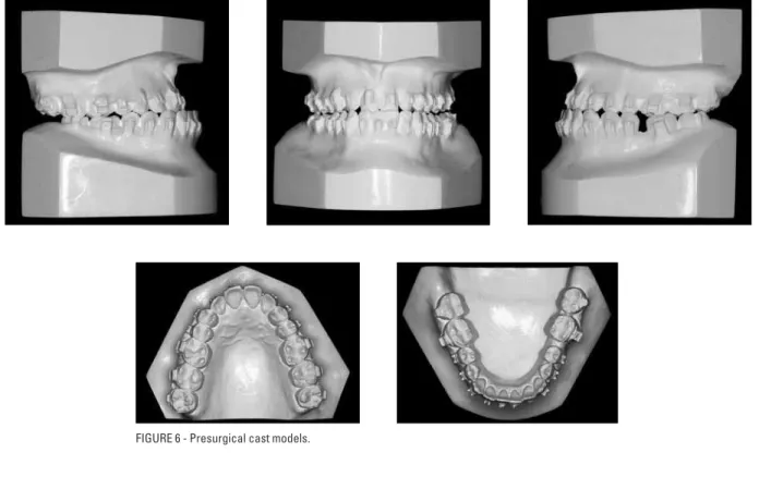 FIGURE 6 - Presurgical cast models.