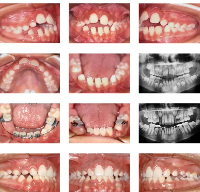 FIGURE 13 - Early treatment of an ectopic right mandibular lateral incisor (Source: Silva Filho, Zinsly, Okada and Ferrari Junior, 29  1996).
