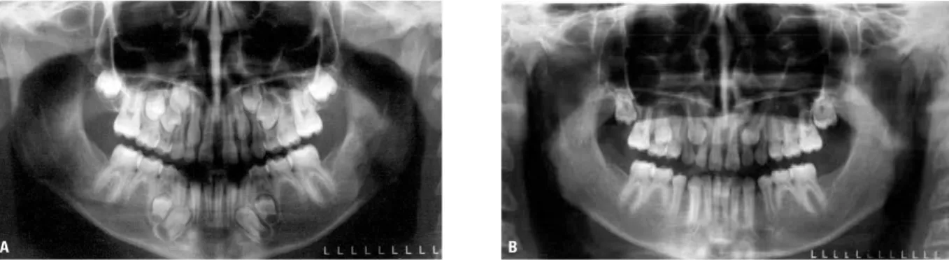 FIGURE 14 - Patient showing agenesis of mandibular second premolars and second molars at 10 year of age ( A ) and at 14 years of age ( B )