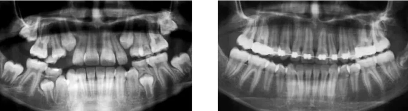 FIGURE 19 - Longitudinal follow up of a mandibular second premolar with distoangulation