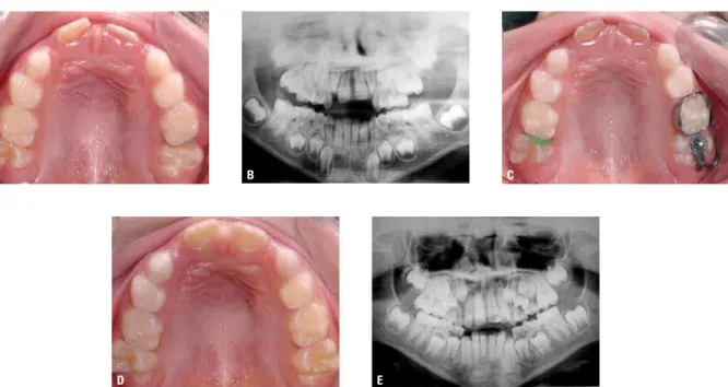 FIGURE 11 - Ectopic eruption of maxillary first molars.  A ) Clinical aspect showing partial eruption of the right first molar