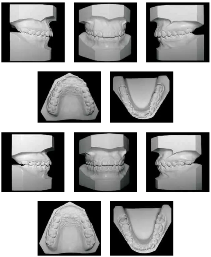 FIGURE 11B - Pretreatment and posttreatment casts.