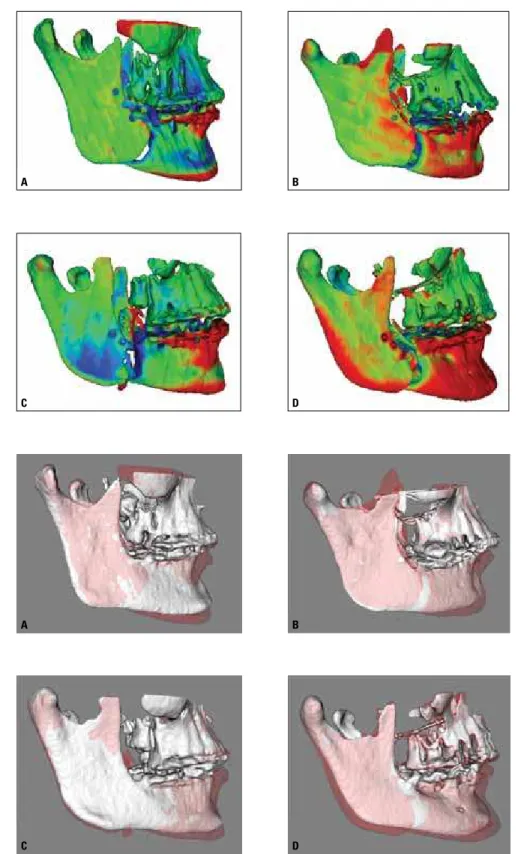 FIGURE 3 - Above: Color maps of surface distances between T1 and T2 models for 4 different patients showing an antero-inferior displacement of the chin  post-surgery with the splint in place