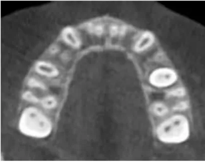 FIGURE 12 - Axial section passing 3.0 mm from  the cemento-enamel junction of the right  max-illary first molar.