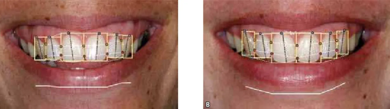 FIGURE 19 - The vertical repositioning of the maxillary incisors and canines, after an ortho-surgical treatment featuring maxillary impaction and rotation,  resulted in an improved relationship between the incisal edges of the maxillary anterior teeth and 