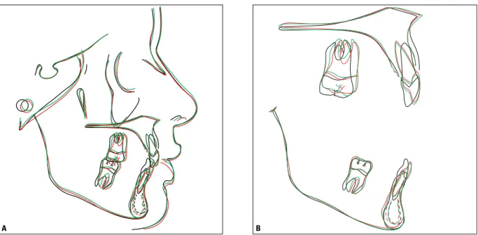 FIGURE 14 - Total ( A ) and partial ( B ) superimposition of initial (black), final (red) and control (green) cephalometric tracings - three years and four months  after treatment completion.
