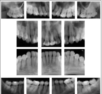 FIGURE 3 - Initial periapical radiographs.