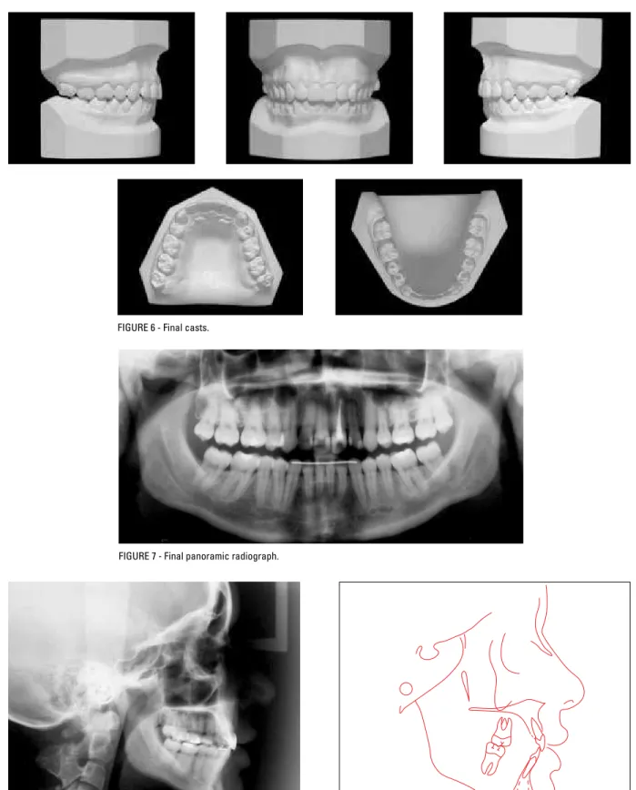 FIGURE 6 - Final casts.