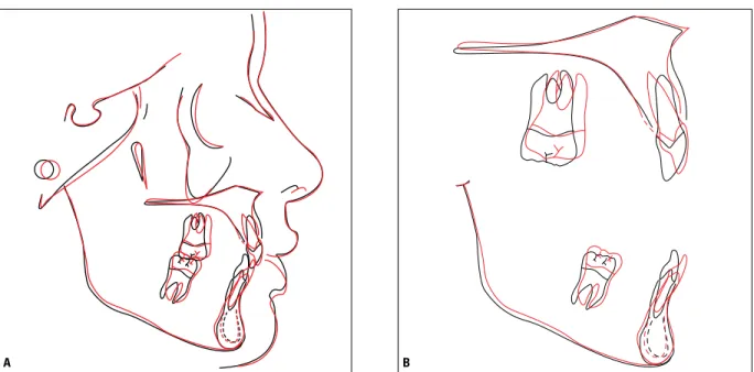 FIGURE 9 - Total ( A ) and partial ( B ) superimposition of initial (black) and final (red) cephalometric tracings.