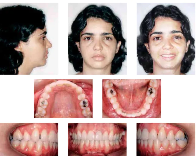 FIGURE 11 - Control casts - three years and four months after treatment completion.