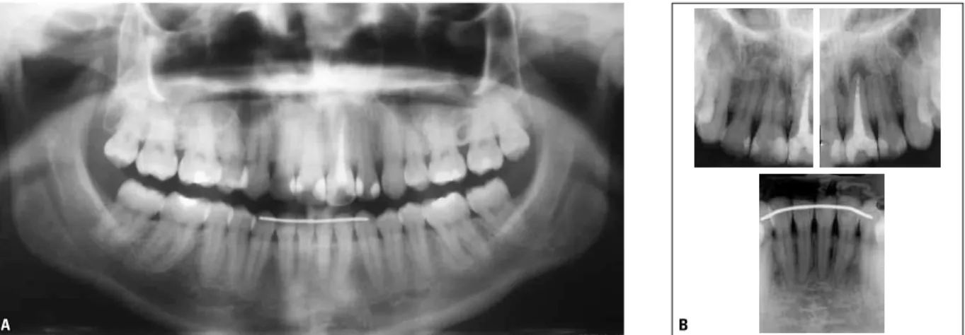 FIGURE 13 - Control cephalometric radiograph ( A ) and cephalometric tracing ( B ) - three years and four months after treatment completion.