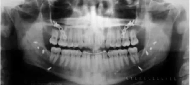 FIGURE 11 - Final panoramic X-ray.