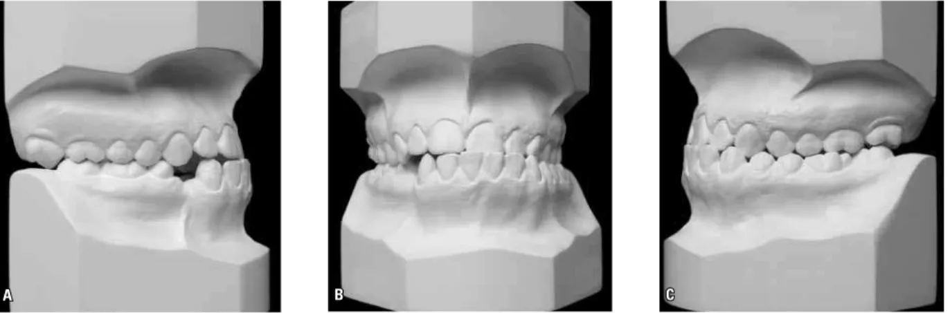 FIGURE 3 - A) Initial panoramic radiograph, B) initial lateral cephalometric radiograph, C) initial cephalometric tracing, D) initial posteroanterior radio- radio-graph, E) initial cephalometric tracing.