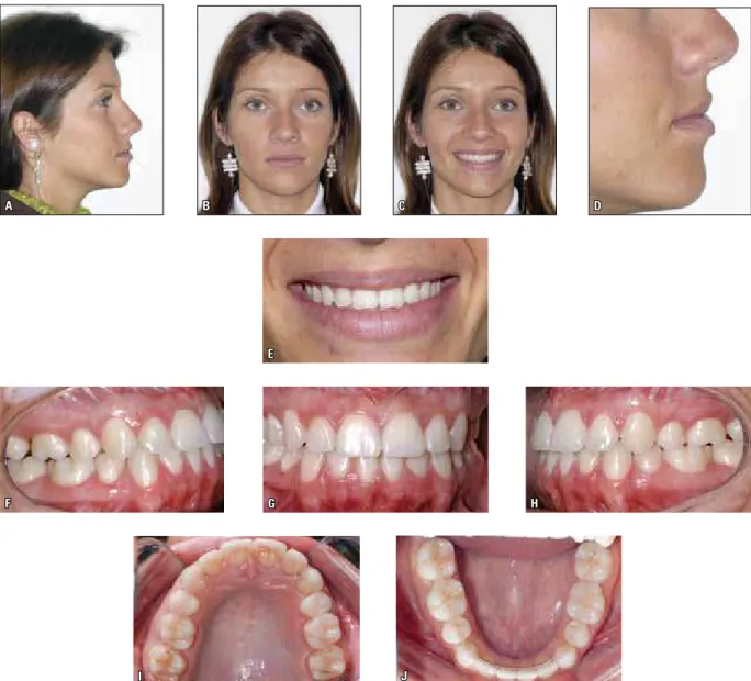 FIGURE 6 - Extraoral ( A, B, C, D, E ) and intraoral ( F, G, H, I, J ) final photographs.