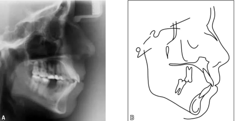 FIGURE 4 - Initial lateral cephalogram (A) and cephalometric tracing (B). 