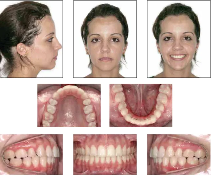 FIGURE 5 - Final facial and intraoral photographs.