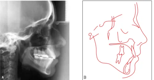 FIGURE 8 - Final lateral cephalogram (A) and cephalometric tracing (B). 