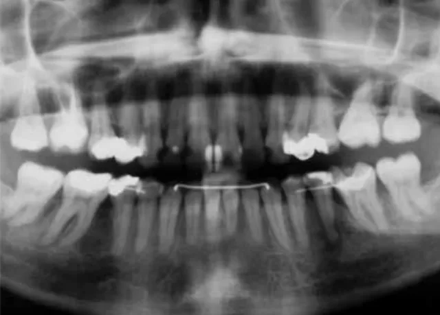 FIGURE 5 - Final panoramic and periapical radiographs.