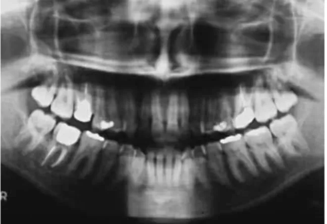 FIGURE 9 - Initial panoramic and periapical radiographs.